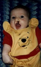 This was taken before my lip repair surgery on my first Halloween, Oct. 31, 1996.